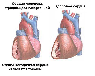 сердце при гипертонии